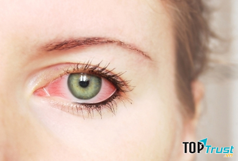 Bệnh đau mắt đỏ