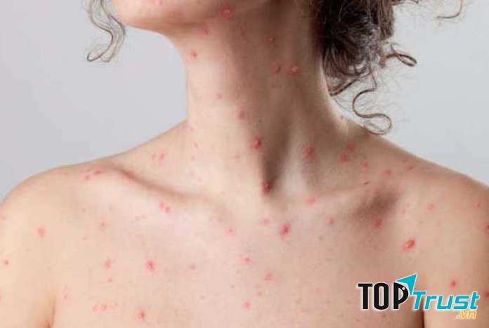 Bệnh thủy đậu