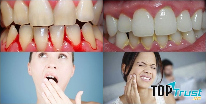 Viêm nha chu là nguyên nhân gây mất răng