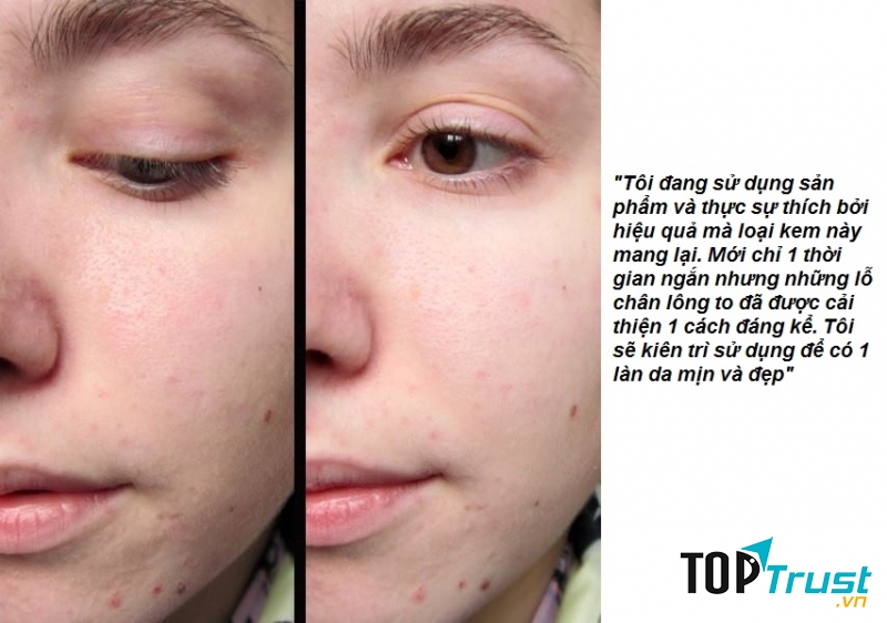 Cảm nhận và kết quả sau khi sử dụng sản phẩm Bioderma Sebium Pore Refiner