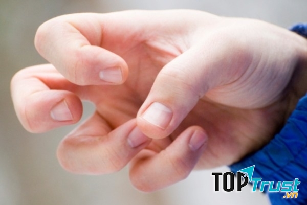 Bệnh động kinh phải uống thuốc suốt đời