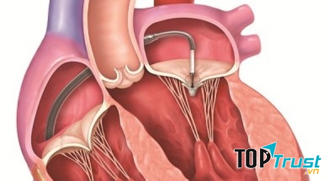 Hở van tim phải uống thuốc điều trị suốt đời