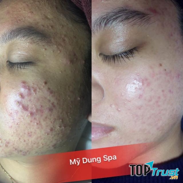 Khách hàng sử dụng liệu trình của Mỹ Dung Spa ngày lần trị liệu đầu của liệu trình