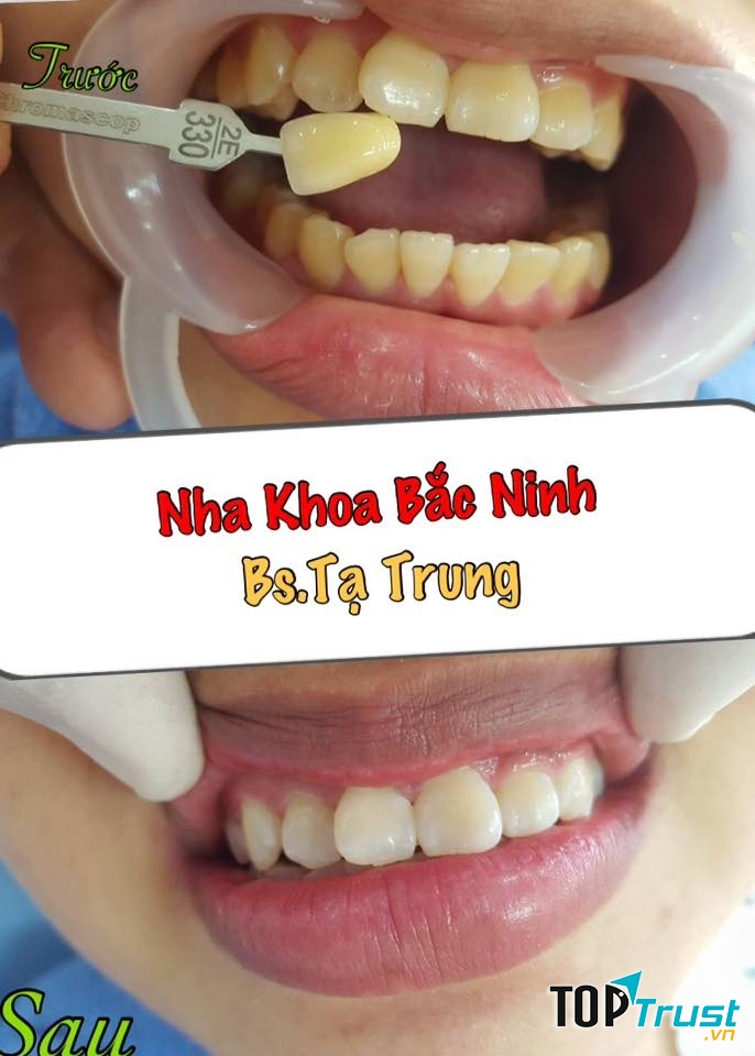 Nha Khoa Bắc Ninh