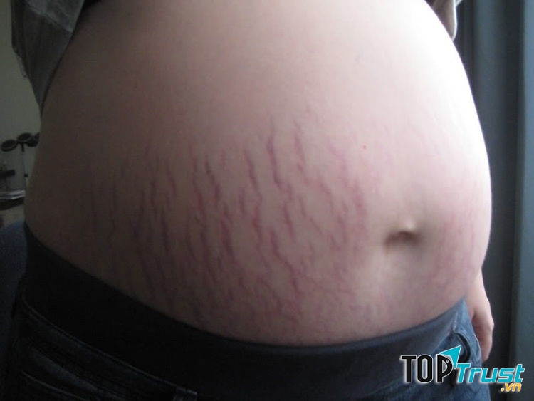 Rạn da thật sự là nỗi ám ảnh với chị em