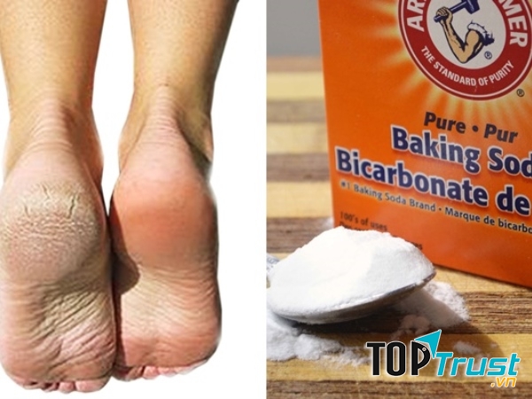 Trị nứt gót chân