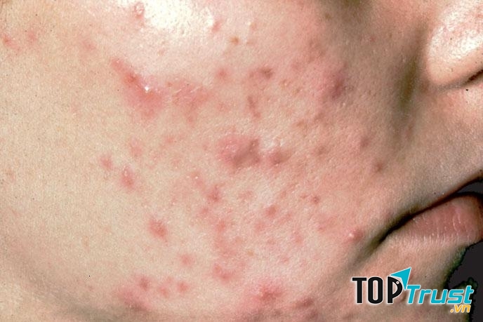 Khi bị bít ở lỗ chân lông, vi khuẩn sẽ nhân lên và có thể dẫn đến sưng đỏ, viêm và thành nốt mụn có mủ- gọi là trứng cá.