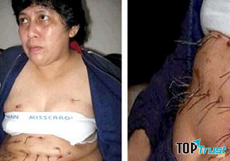 Người phụ nữ mọc ra kim loại