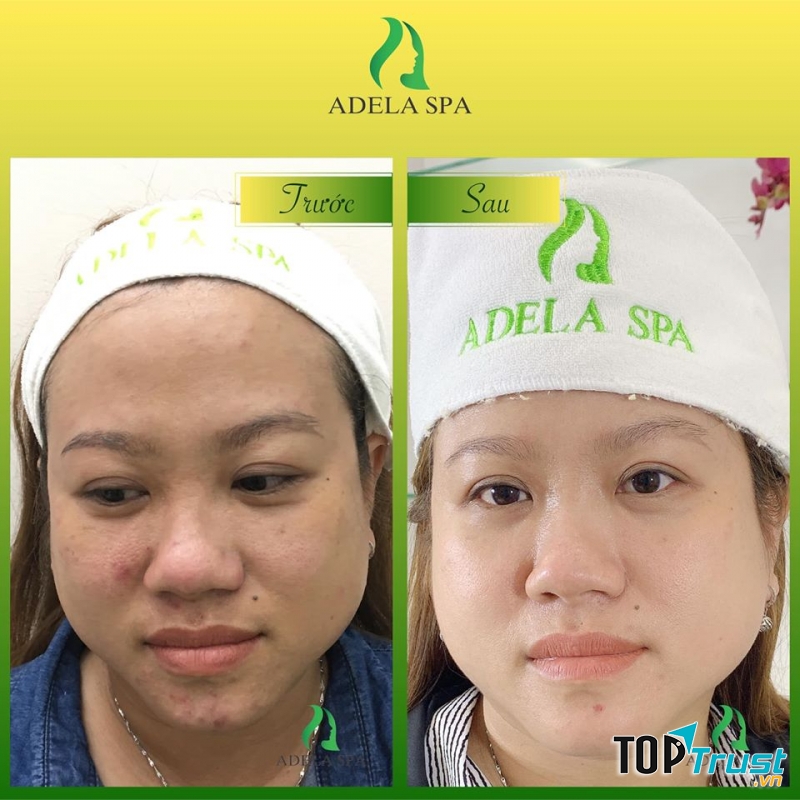 Làm đẹp tại Adela Spa