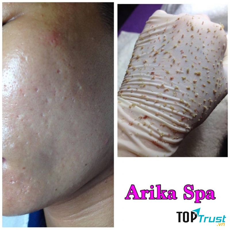Akira Spa trị mụn bằng phương pháp lấy nhân mụn