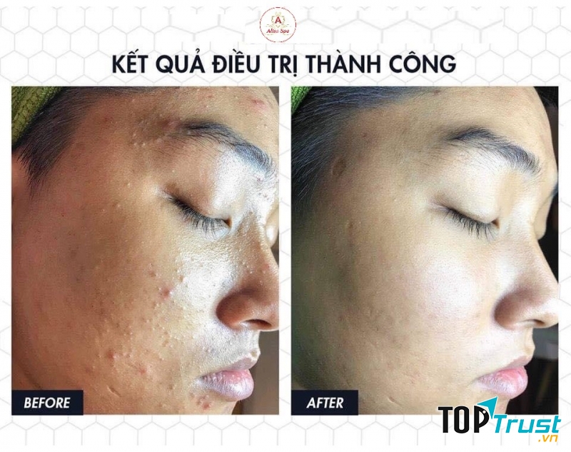 Alisa Spa Thanh Hóa