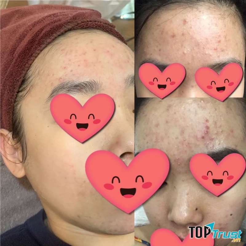 Khách hàng sau khi điều trị tại Ẩm, da đều có chuyển biến rõ rệt.