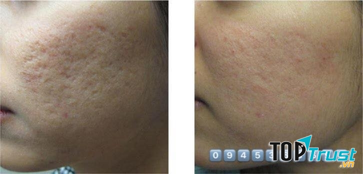 Tình trạng sẹo rỗ sau mụn được spa khắc phục khá triệt để