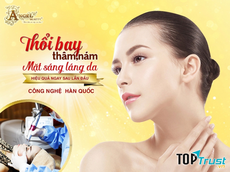 Điều trị nám tại Angel Beauty