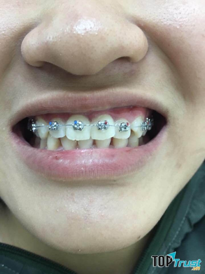 Bác Sĩ Toàn Niềng Răng