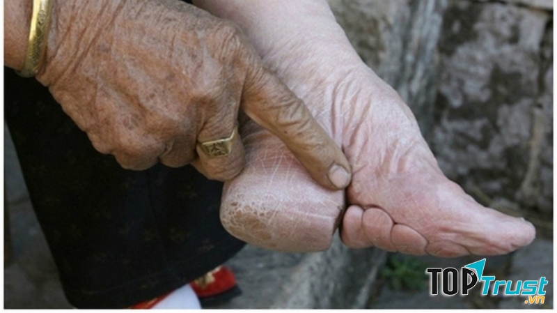 Bàn chân gót sen tượng trưng cho đức hạnh và phẩm giá của người phụ nữ phong kiến Trung Quốc