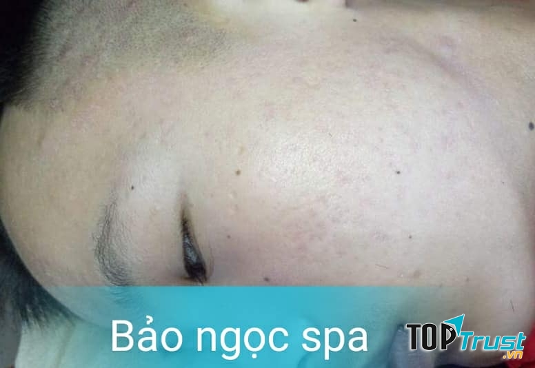 Da khách hàng sau một liệu trình trị mụn tại Bảo Ngọc Spa