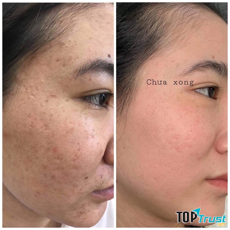 Bảo Sanh Liên Trị Nám Mụn Long Khánh