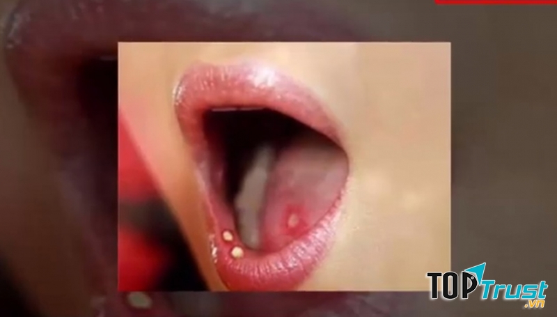 Bề mặt lưỡi sần sùi