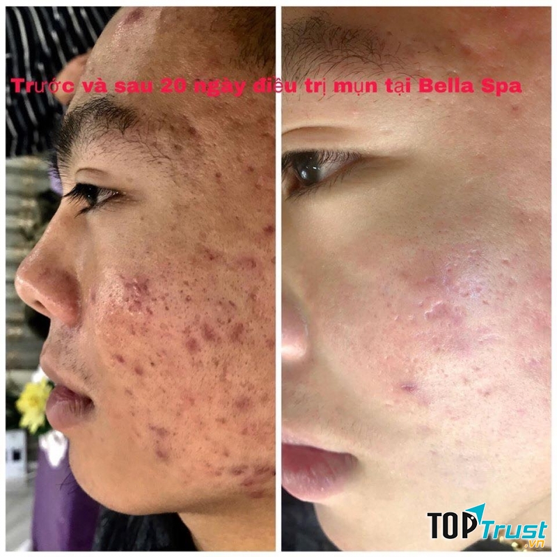 Kết quả đợt điều tri mụn của khách hàng tại Bella Spa.