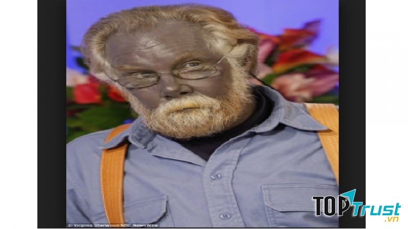 Paul Karason bị bệnh Argyria khiến làn da của ông có màu xanh