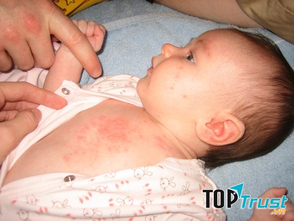 Trẻ mắc bệnh ban đỏ có biểu hiện sốt nhẹ, khó chịu, xuất hiện những mảng đỏ từ 1- 4 ngày ở mặt rồi ban lan xuống cánh tay, toàn thân và chân.