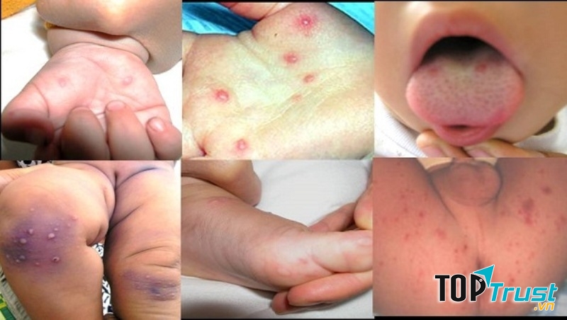 Bệnh chân tay miệng ở trẻ em