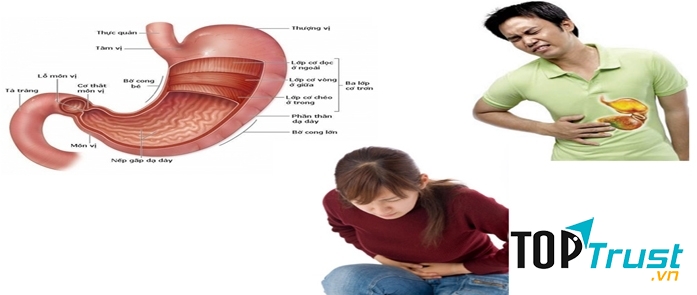 Bệnh đau dạ dày với những cơn đau dữ dội