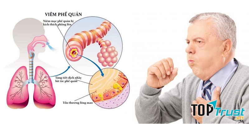 Bệnh đường hô hấp