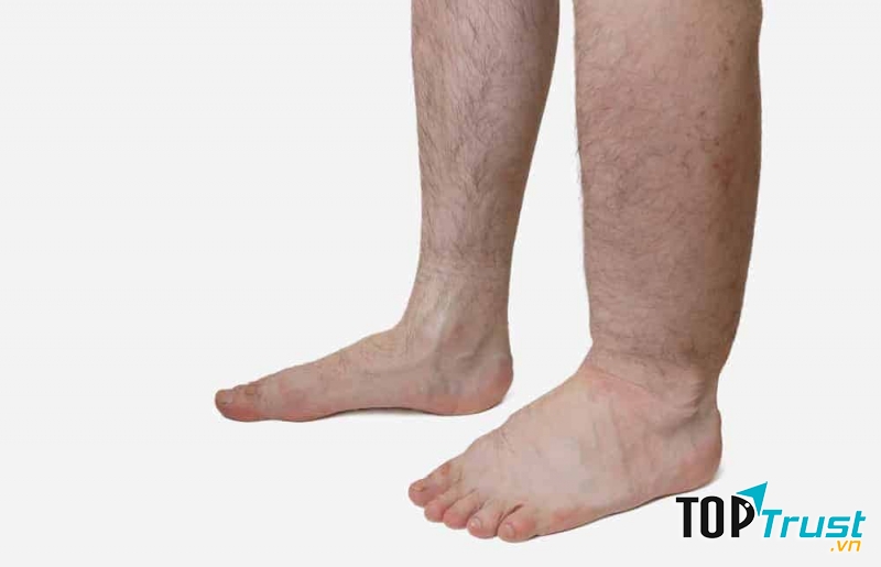 Bệnh giun chỉ bạch huyết (chân, tay voi)