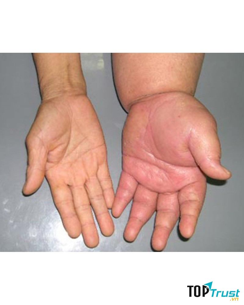 Bệnh giun chỉ bạch huyết (chân, tay voi)