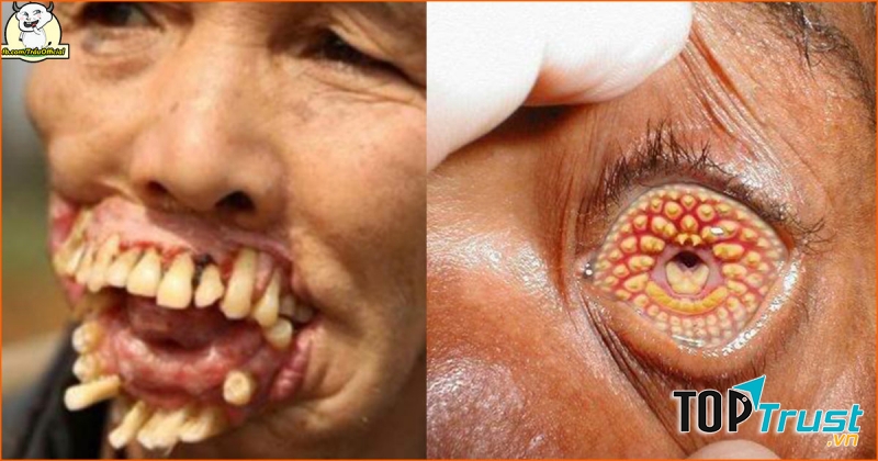 Bệnh Lamprey (Lamprey disease)