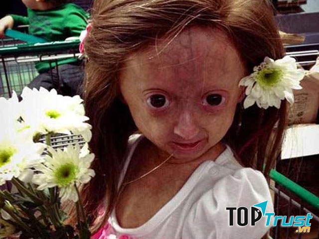 Bệnh lão hóa sớm