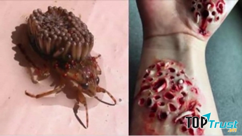 Bệnh nhiễm trùng giòi maggot