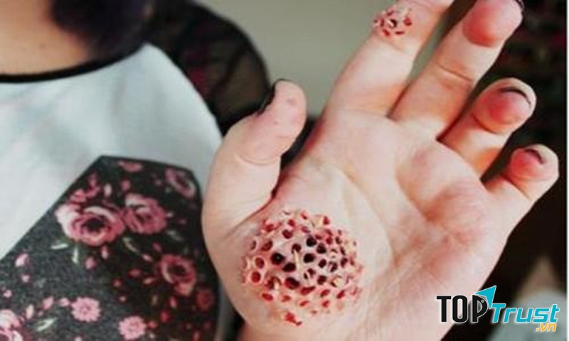 Bệnh nhiễm trùng giòi maggot