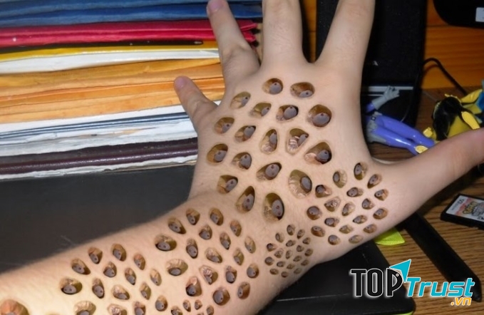 Bệnh nhiễm trùng giòi maggot