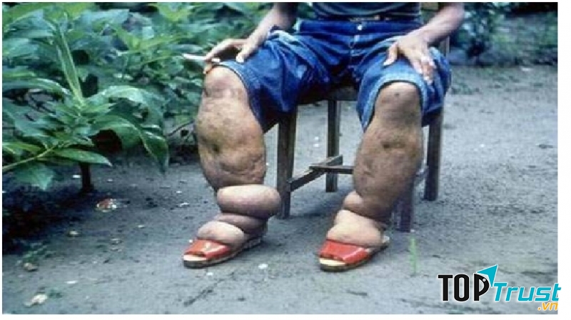 Bệnh nhân bị mắc hội chứng chân voi
