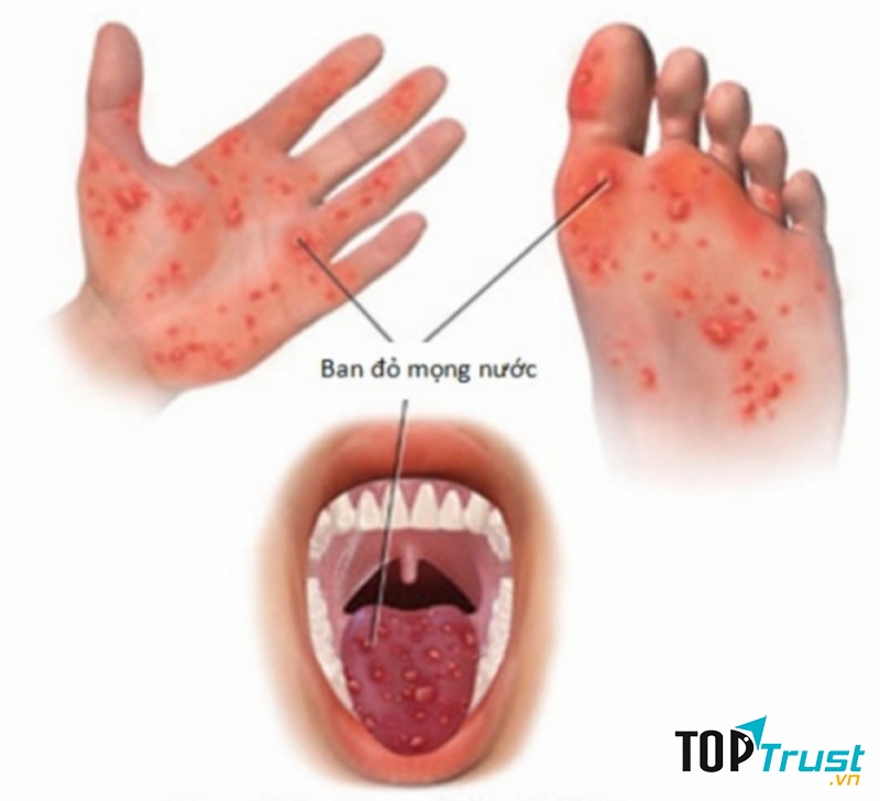 Triệu chứng của bệnh tay chân miệng.