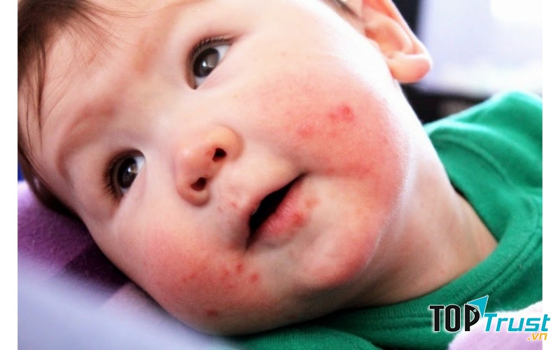 ệnh lây từ người sang người qua tiếp xúc trực tiếp với người bệnh hoặc gián tiếp qua đồ dùng, vật dụng bị nhiễm virus từ dịch tiết mũi họng, các bọng nước vỡ của người bệnh.