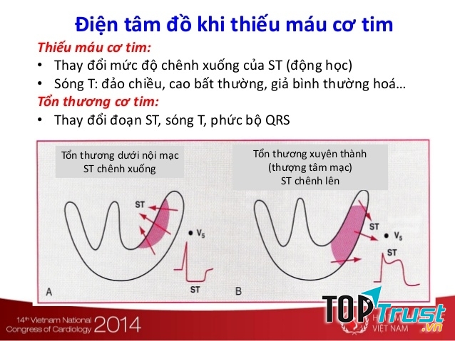 Điện tâm đồ khi thiếu máu cơ tim