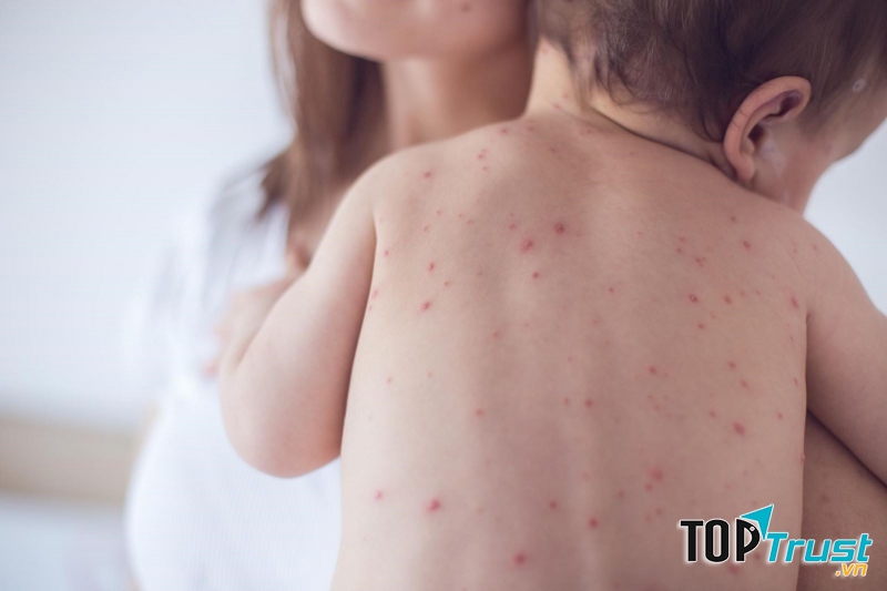 Bệnh thủy đậu là một bệnh cấp tính do nhiễm virus Varicella Zoter gây ra