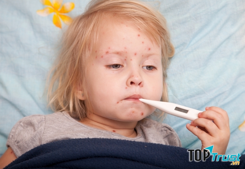 Một em bé bị thủy đậu