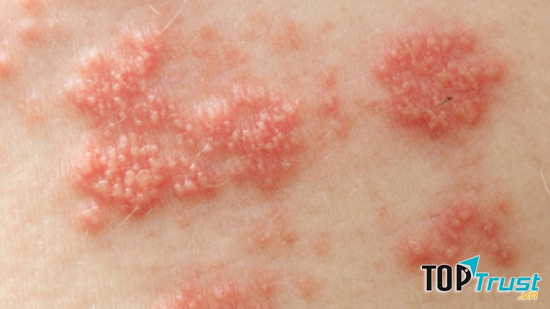 Hình ảnh u sùi- sùi mào gà