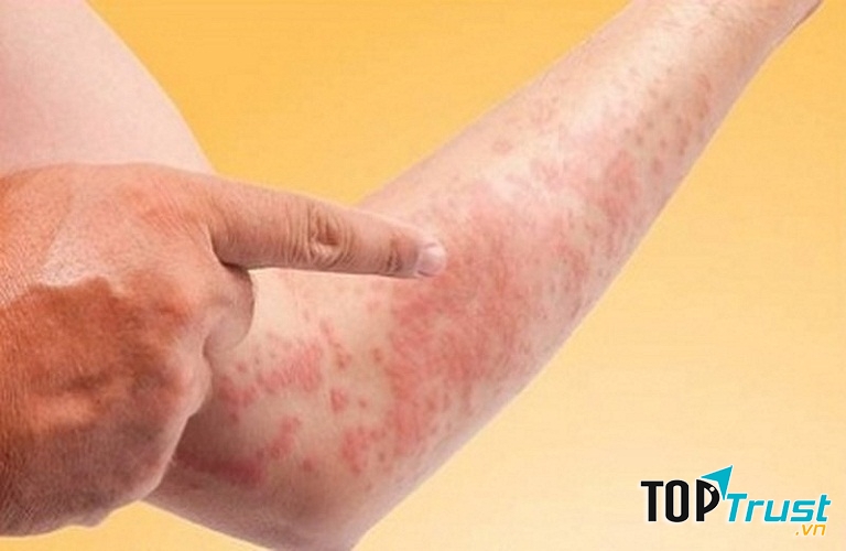 Bệnh ngoài da là nhóm bệnh phổ biến trong cộng đồng về mùa đông