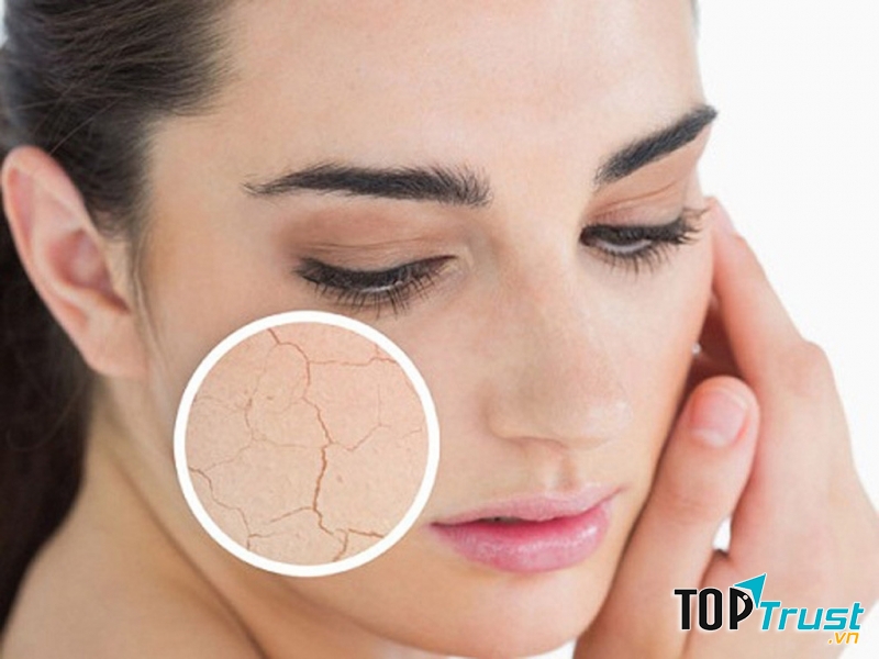 Mùa đông thường khiến da khô