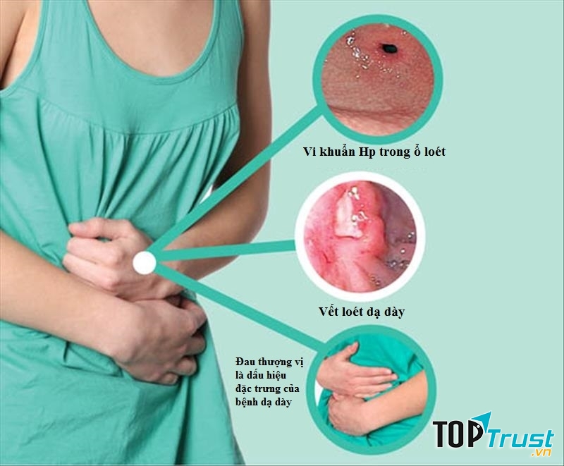 Bệnh viêm loét dạ dày, tá tràng