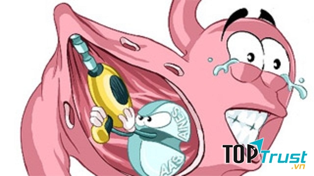 Triệu chứng, biểu hiện loét dạ dày - tá tràng