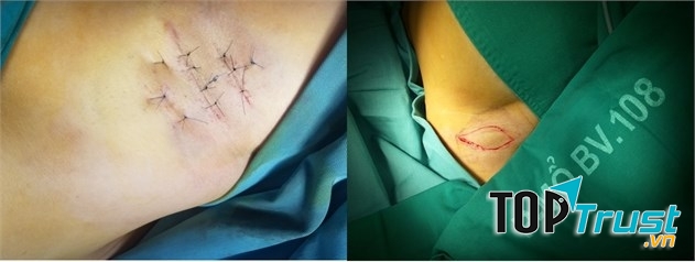 : Phẫu thuật mổ mở đường mổ nhỏ và phẫu thuật cắt vạt da