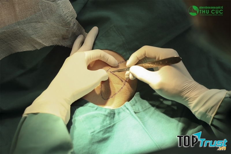 Phẩu thuật cắt tuyến mồ hôi nách