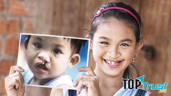 Nhiều trẻ em được phẫu thuật hở hàm ếch